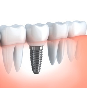 Senioren: Zahn-Implantate verbessern Lebensqualität