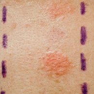 Allergietest (Pricktest)