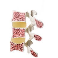 Knochendichte-Messung (Osteo-Densitometrie)