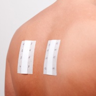 Epikutantest (Läppchentest)