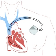 Herzschrittmacher
