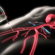 PTCA (Herzkranzgefäß-Erweiterung)