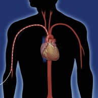Rotationsangioplastie