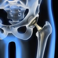 Hüftgelenk, künstlich