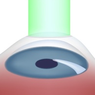 Lasik - Korrektur der Fehlsichtigkeit durch Laser-OP