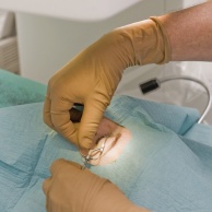 Augenmuskel-Operation