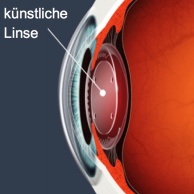 Intraokularlinsen