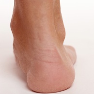 Achillessehnenriss (Achillessehnenruptur)