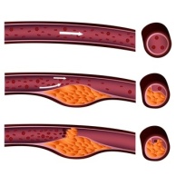 Arteriosklerose (Arterienverkalkung, Gefäßverkalkung)