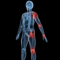 Arthrose (Gelenkabnutzung)