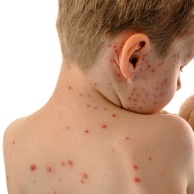 Arzneimittelexanthem bei Baby und Kind