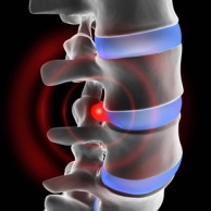 Bandscheibenvorfall (Diskusprolaps)