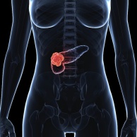 Bauchspeicheldrüsenkrebs (Pankreaskarzinom)
