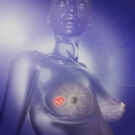 Brustkrebs (Mammakarzinom)