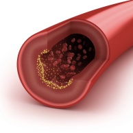 Erhöhter Cholesterinspiegel