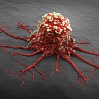 Chronisch lymphatische Leukämie (CLL)