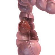 Darmkrebs (Kolorektales Karzinom)