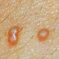 Dellwarzen (Mollusca contagiosa)