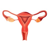 Endometriose (Wucherung der Gebärmutterschleimhaut)