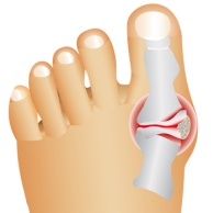 Hallux Valgus (Ballengroßzehe)