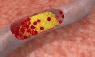 Cholesterin-senkende Lebensmittel schützen nicht sicher vor Infarkt