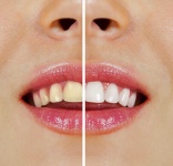 Weiße Zähne mit Wasserstoffperoxid