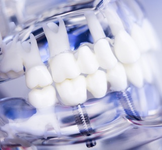Neue Zahnimplantate schützen vor Infektion