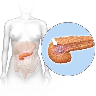 Krebs der Bauchspeicheldrüse weit verbreitet